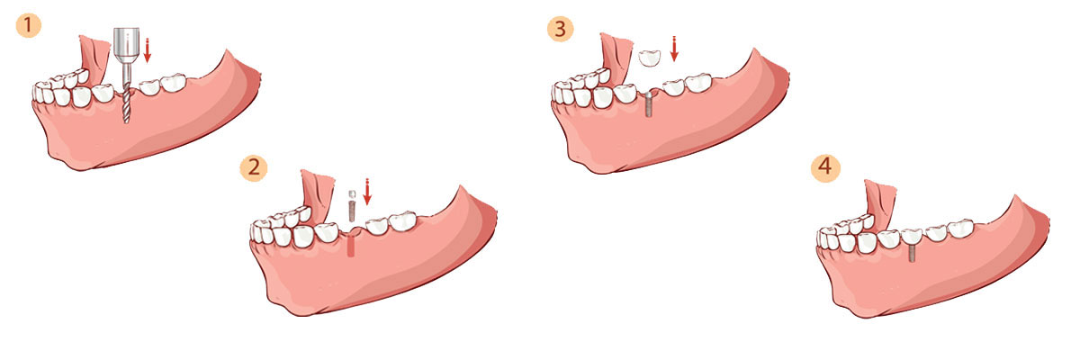 Mason Dental Implant Restoration