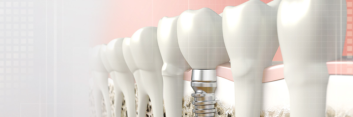 Mason Implant Dentist