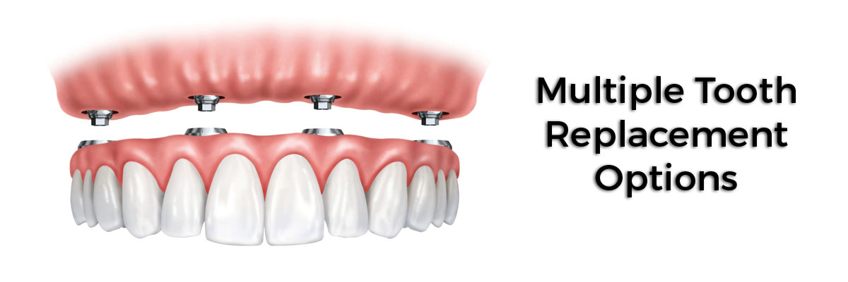 Mason Multiple Teeth Replacement Options